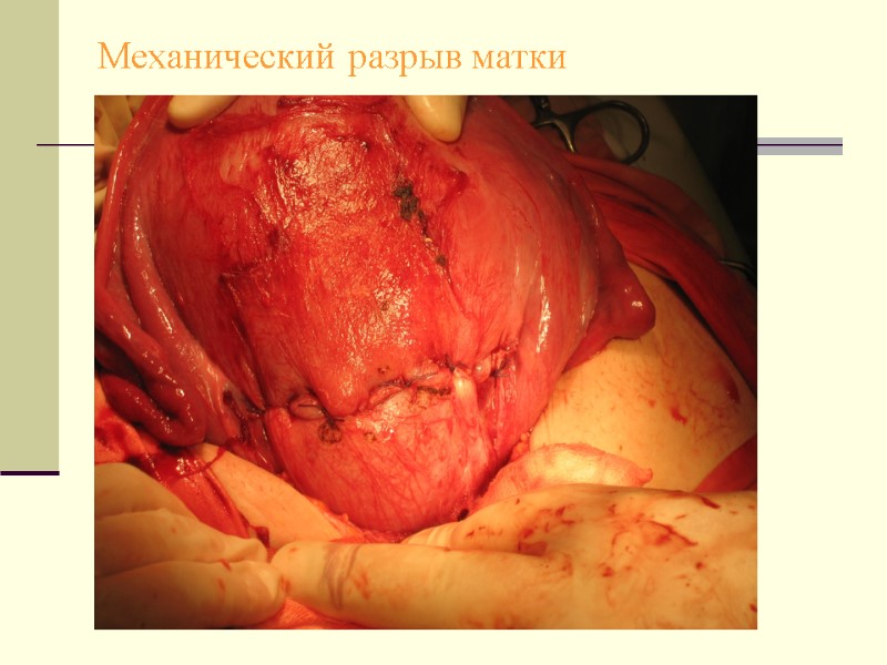 Механический разрыв матки